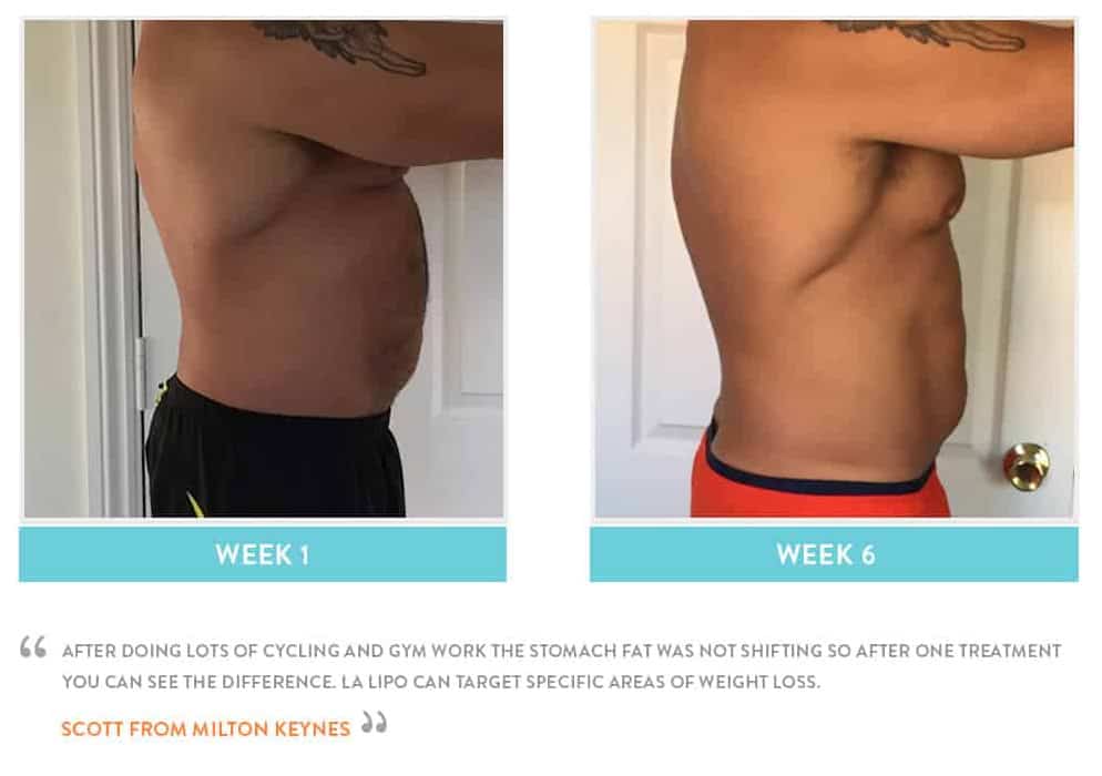 Before & After Stomach Fat Brighton