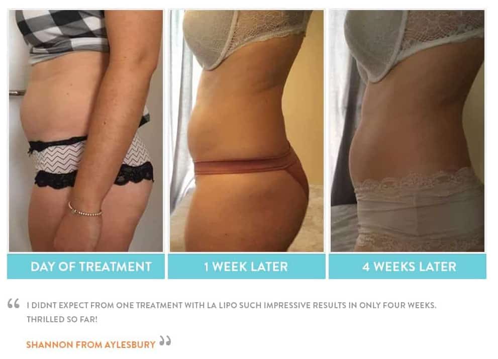 before, Cryolipolysis Brighton