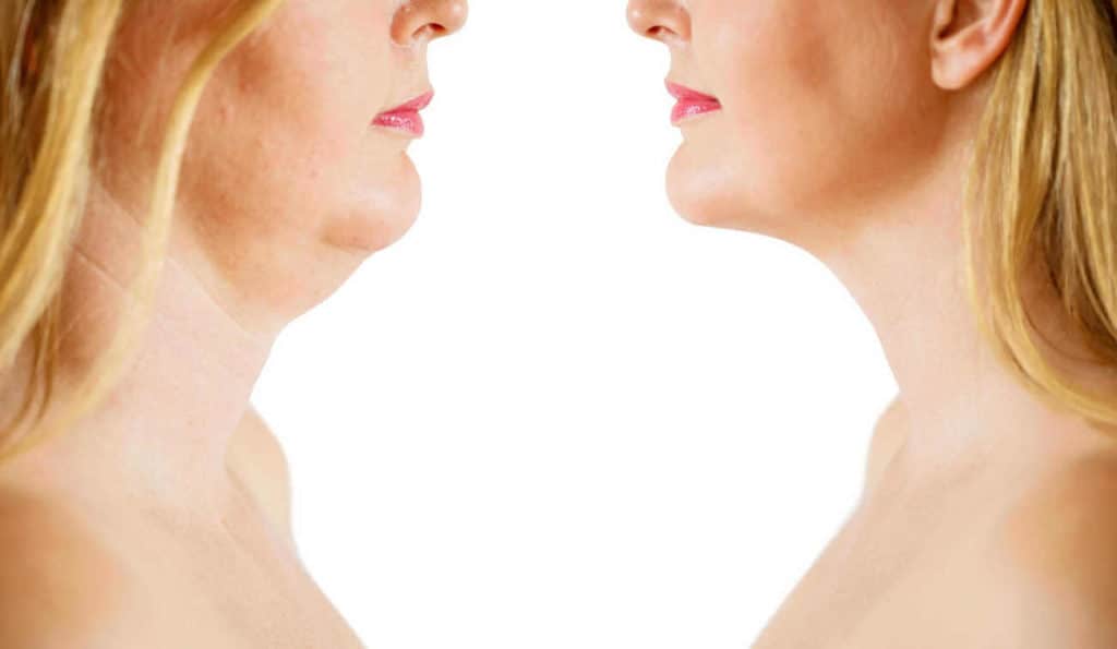 Double Chin treatment Brighton before and after results