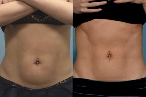 body sculpting FAQs Brighton