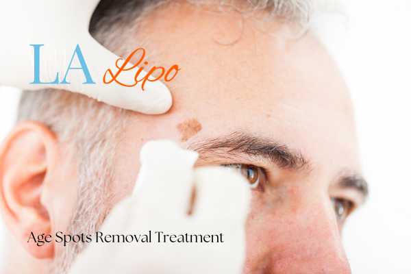 What Are the Most Effective Treatments for Age Spots Brighton?