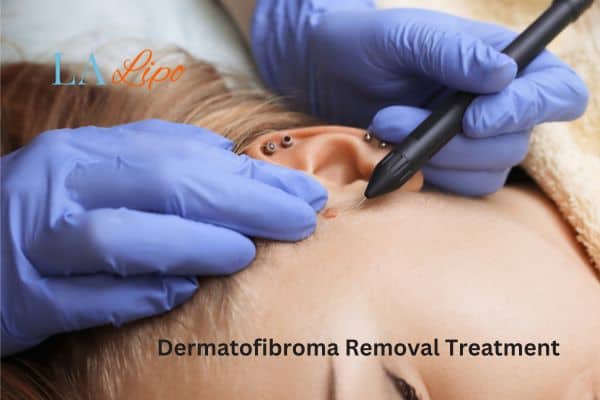 Dermatofibroma Removal Treatment Brighton