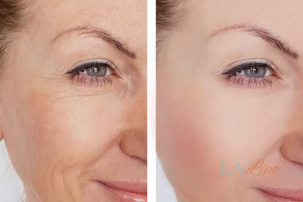 before; after; hifu