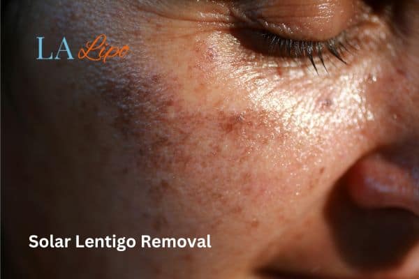 solar lentigo
