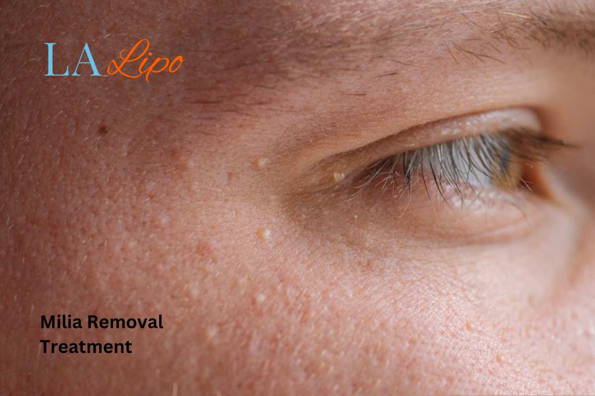 Cryopen Milia Removal: Is It the Easiest and Safest Option Brighton?