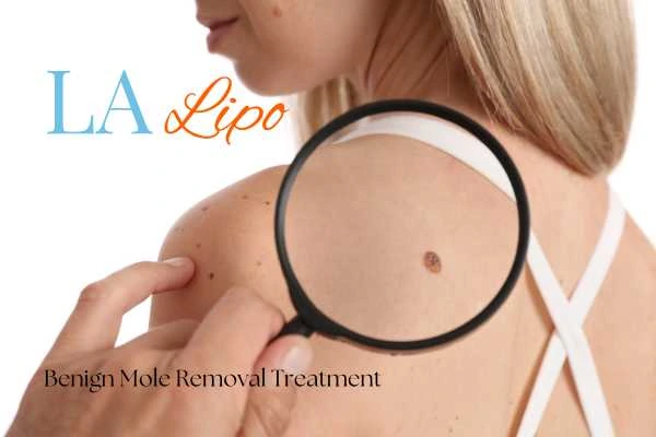 Why getting moles removed Brighton can boost your confidence!