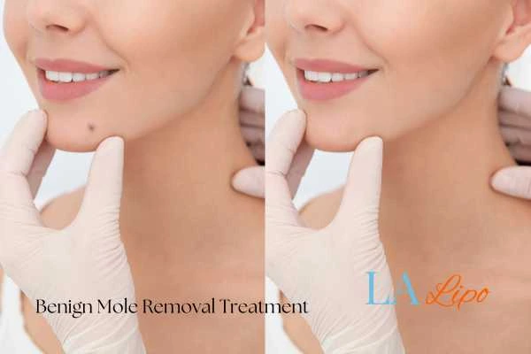 Woman's before and after results of being moles removal treatment Brighton