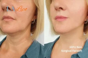 hi-fu for wrinkles Brighton before and after results