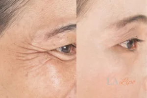 Before and after results of woman - HI-fu wrinkles reduction treatment Brighton