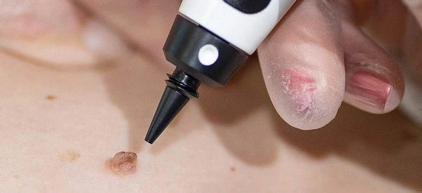 skin tag removal using cryopen Brighton