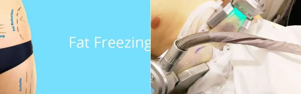 Fat freezing Brighton on multiple areas of the body