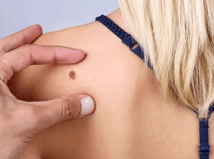 woman having mole removal Brighton consultation before treatment.