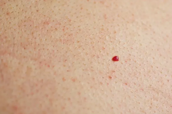 close up of a cherry angioma Brighton