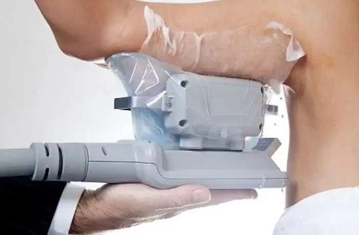 Picture of fat freezing Brighton on the upper arms.