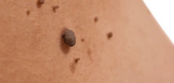 image of a skin tag Brighton
