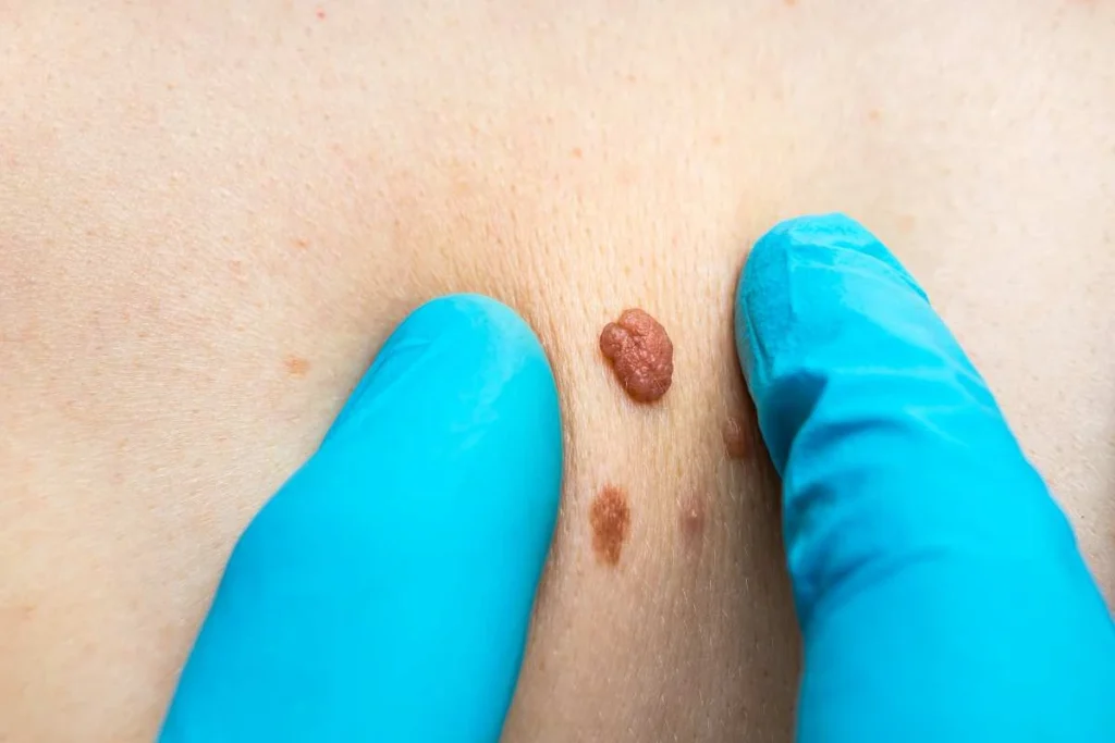 Consultant examining a skin tag Brighton