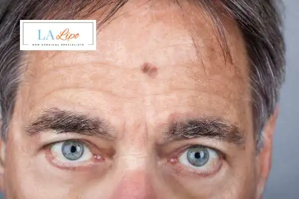 Solar Lentigo Removal Brighton image of man with mark on his forehead
