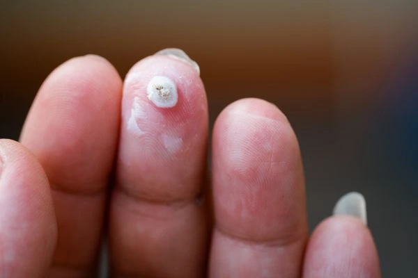 wart on person finger - cryotherapy to treat from LA LIPO Brighton