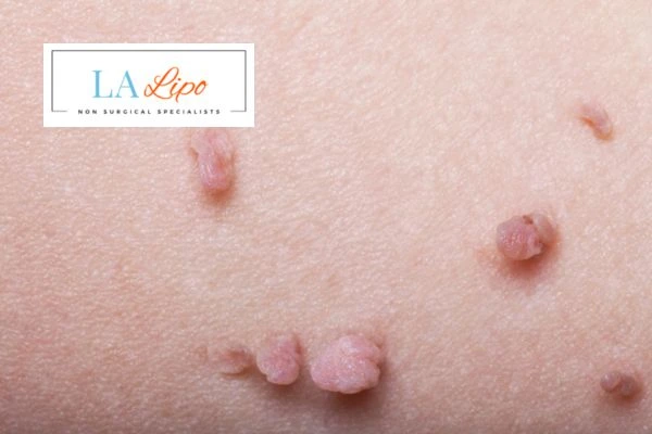 Does cryopen skin tag removal Brighton hurt? Find out now call our team today!