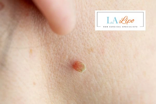 Book skin tag removal Brighton today speak to our team now!