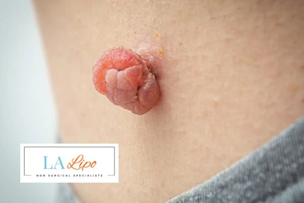 Interested in skin tag removal Brighton? Concerned about the pain? Find out more today!