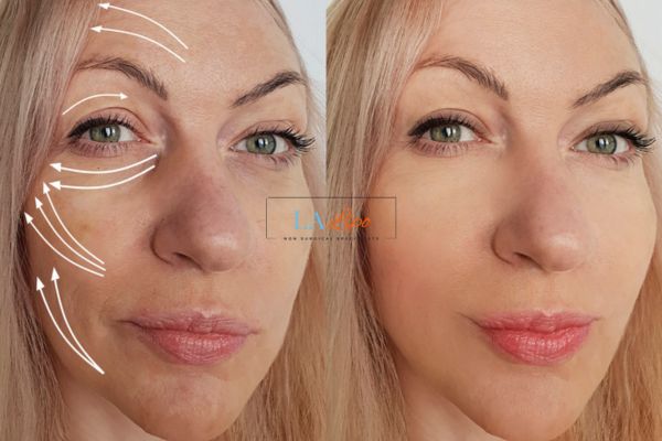 Morpheus 8 results Brighton face lift.