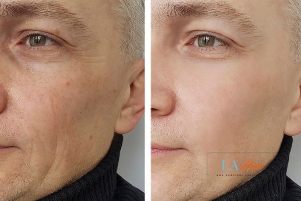 See the amazing results of Morpheus8 Treatment Brighton!