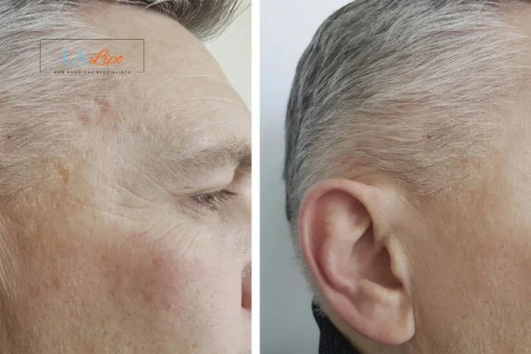 Mens Before & After Morpheus 8 Results Brighton