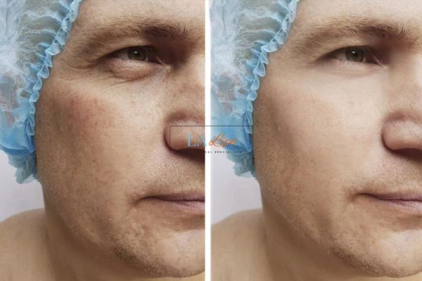 Before and after Morpheus 8 Results Brighton