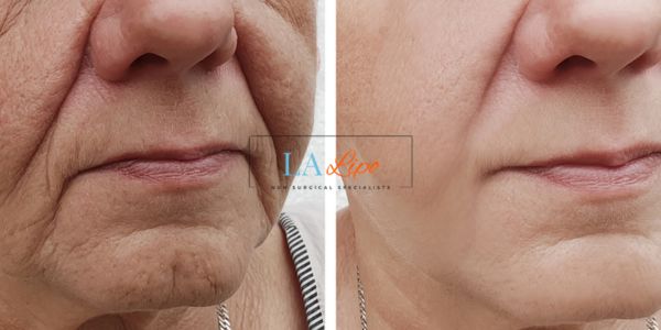 Older lady deeper wrinkle reduction - LA LIPO Morpheus 8 Results Brighton