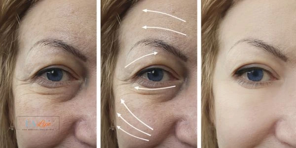 Amazing eye lift Morpheus 8 results Brighton