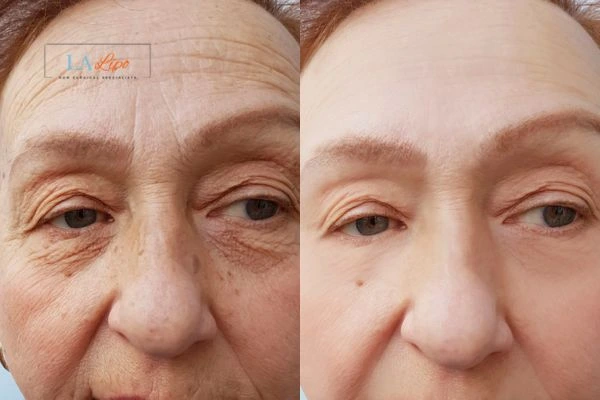 The powerful benefits of Morpheus8 Treatment Brighton - Call Our team today!