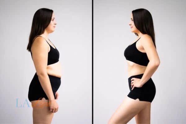 Picture of womans before and after using LA-EMS body sculpting to improve her core strength Brighton