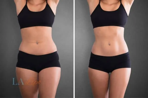 before and after results of non-surgical treatment to help a woman's body image and mental health Brighton