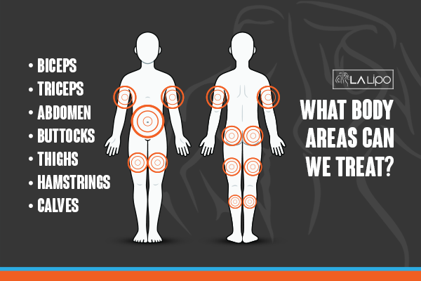 Diagram to show areas you can have LA-EMS Body Sculpting Treatment Brighton