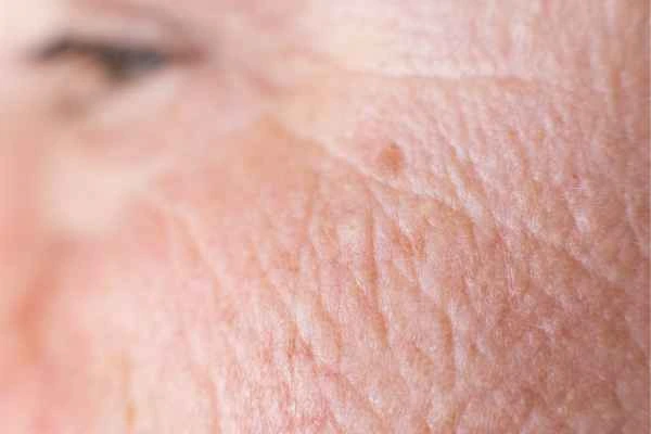 close up picture of a woman's face showing an age spot Brighton