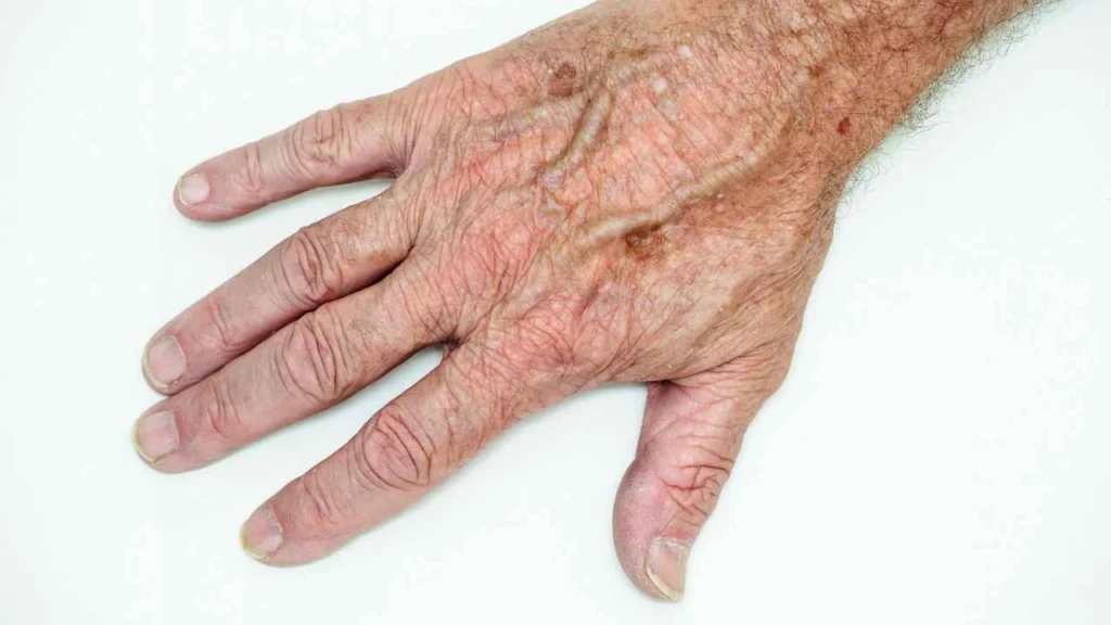 Male hand showing age spot Brighton