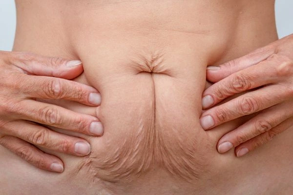 Image of a woman's stomach with loose skin - example of skin tightening Brighton options
