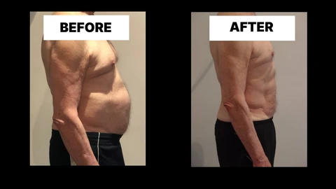 What Symptoms Can Diastasis Recti Cause in Men? Weak Core, Back Pain and Poor Posture Brighton